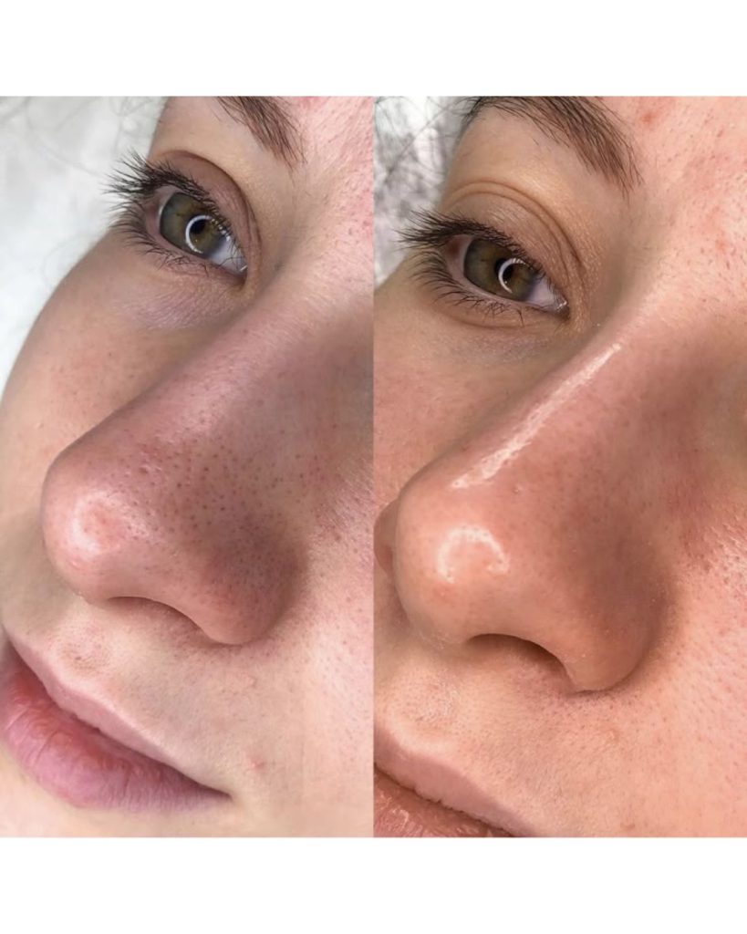 Blackhead removal before and after: nose with visible blackheads on the left, clearer pores on the right