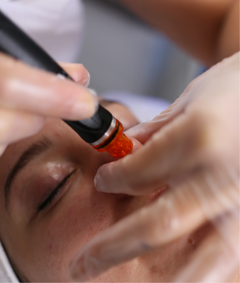 Handpiece with peel solution on the cheek - treating blemished skin during acne care in Vienna