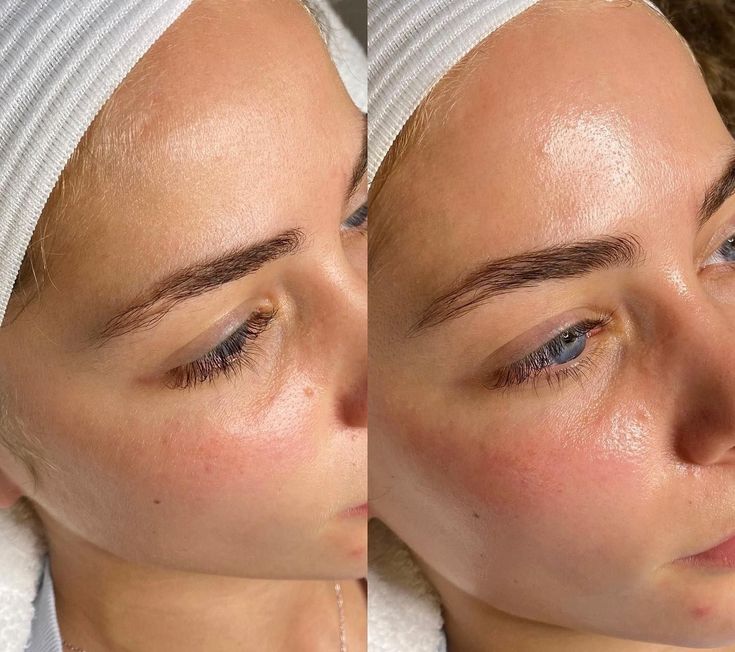 Before and after of the cheek with a fresh glow - JetPeel treatment result in Vienna