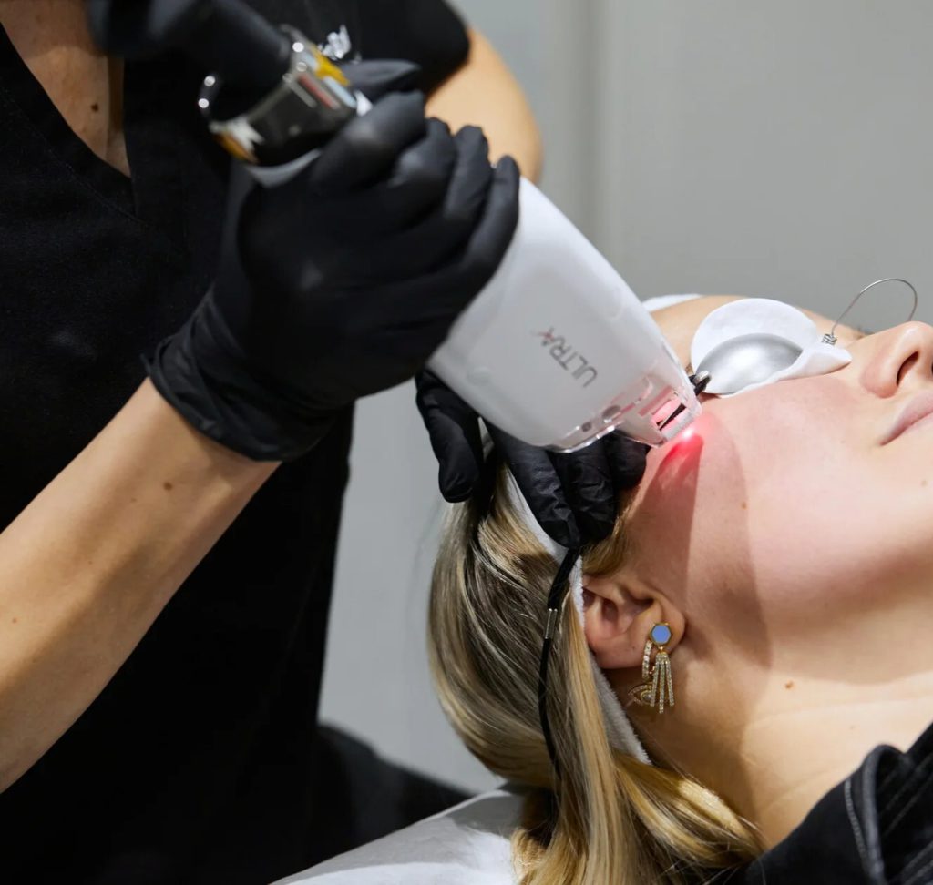 Kosmetikerin führt den Thulium-Laser ULTRA über die Wange einer Kundin mit Augenschutz