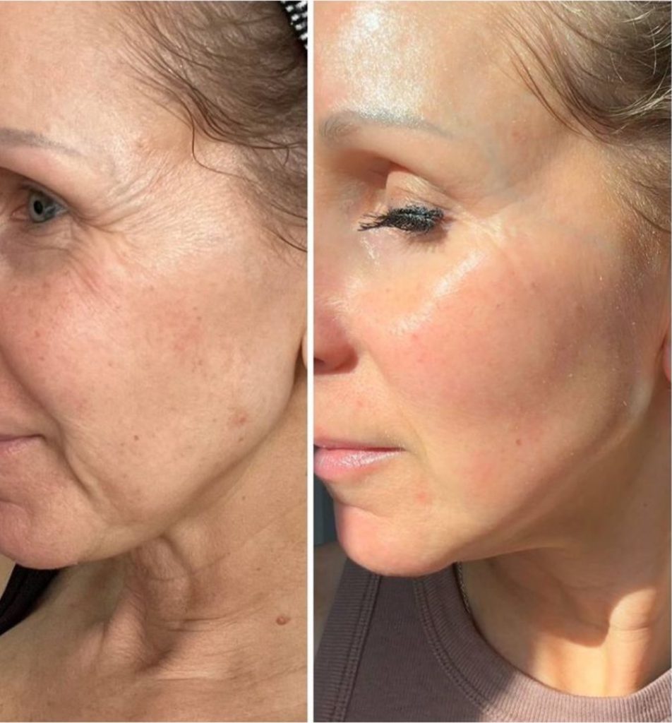 Vorher-Nachher der Wange mit glatterer Haut - Ergebnis der Thulium Laser Behandlung in Wien