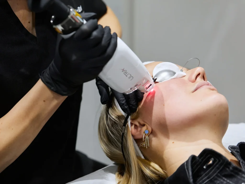 Laser handpiece on the face, client wearing eye shields - pigmentation removal in Vienna