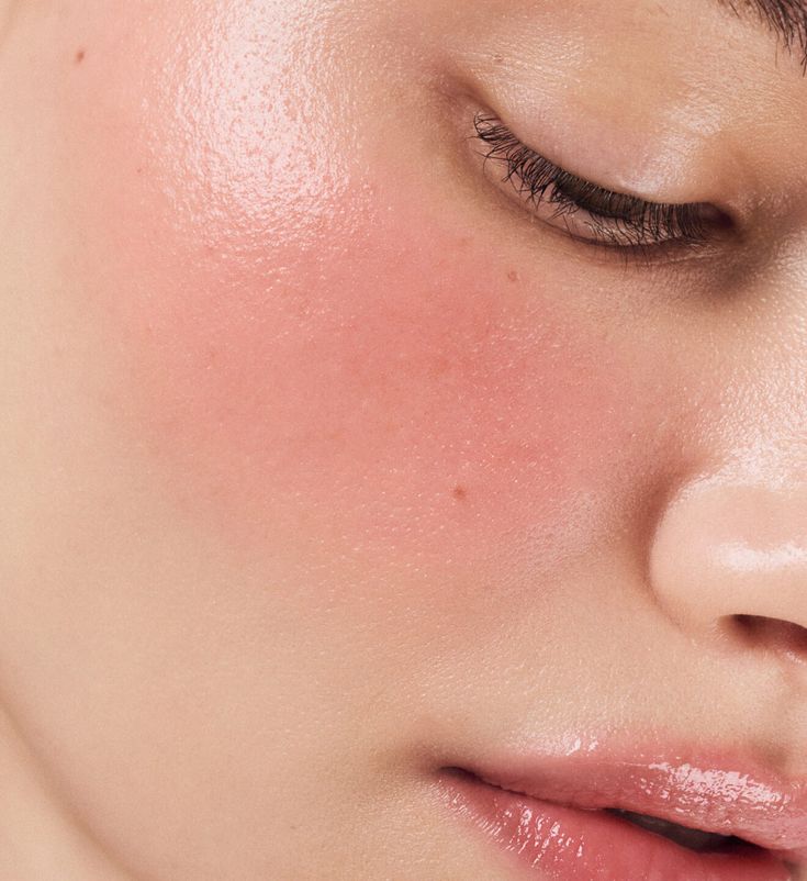 Close-up of a cheek with a fresh glow after the laser facial in Vienna