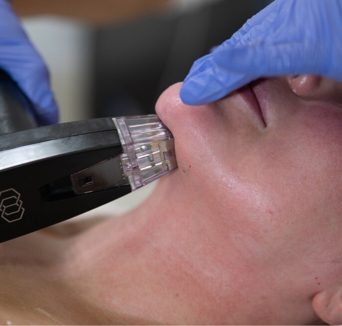 Needling handpiece on the chin area during a microneedling treatment in Vienna