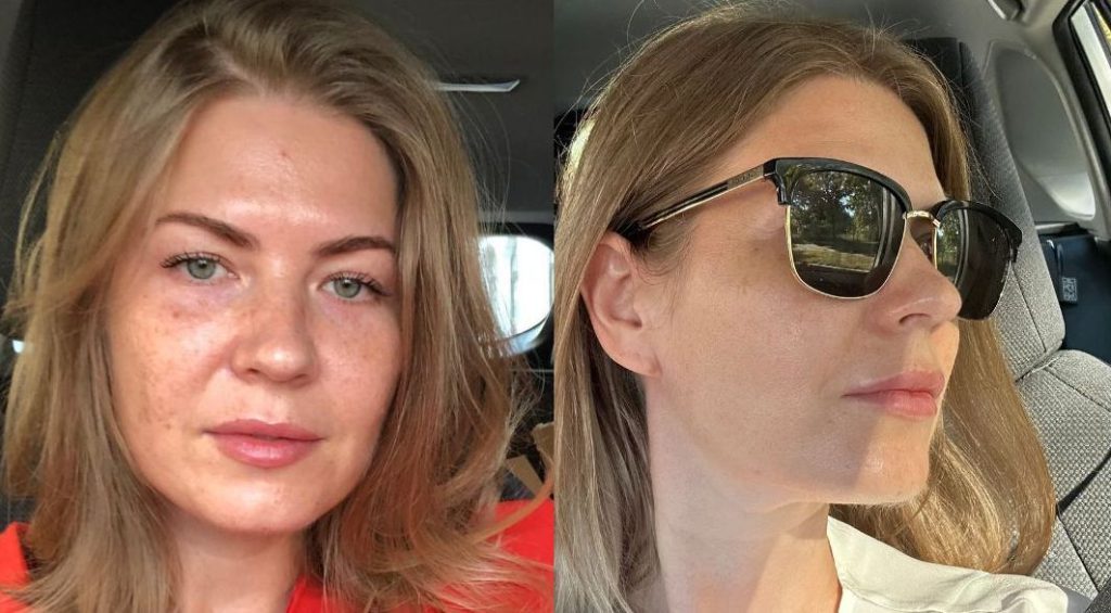 Before and after selfies with a more even complexion - pigmentation treatment in Vienna